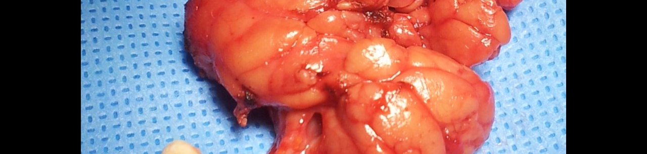 IPVZ kurz: Obstrukční patologie slinných žláz