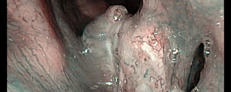 Zpráva z&nbsp;IPVZ kurzu: Narrow Band Imaging