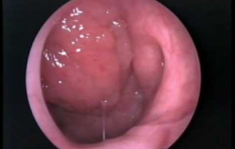 Doporučený postup předoperačního vyšetření před adenotomií a&nbsp;tonzilektomií u&nbsp;dětí